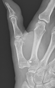 母指CM関節症の手術後のレントゲン図2