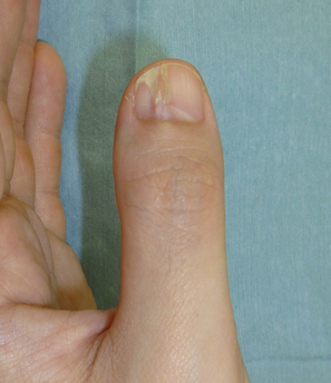 グロームス腫瘍（爪下腫瘍）の症状のイメージ