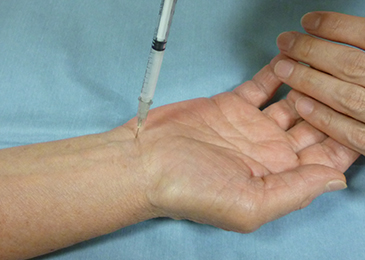 ブロック注射による手根管症候群の治療