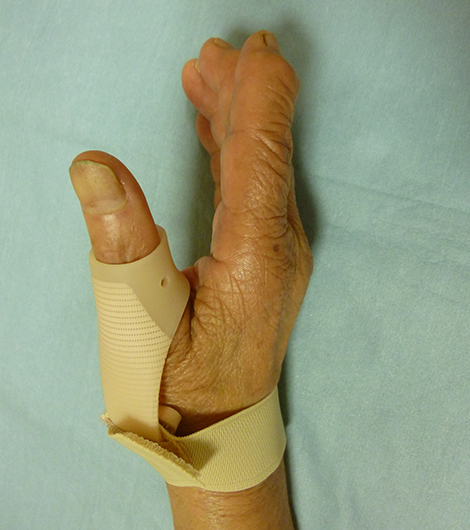 装具による母指CM関節症の治療1