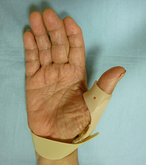 装具による母指CM関節症の治療2