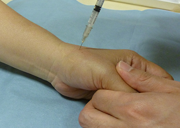 ステロイド注射による母指CM関節症の治療