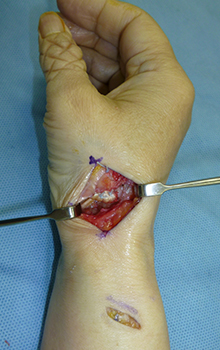 手術による母指CM関節症の治療の流れ2