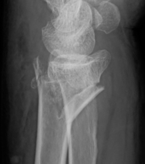 橈骨遠位端骨折のレントゲン図2