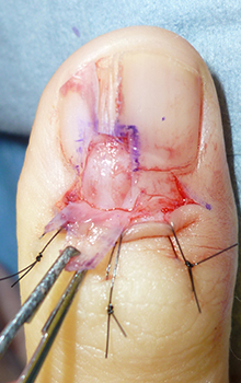 手術によるグロームス腫瘍（爪下腫瘍）の治療の流れ2