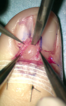 手術によるグロームス腫瘍（爪下腫瘍）の治療の流れ3