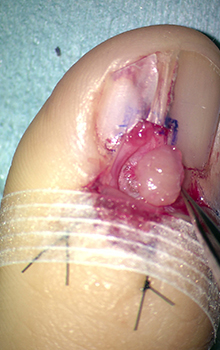 手術によるグロームス腫瘍（爪下腫瘍）の治療の流れ4