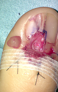 手術によるグロームス腫瘍（爪下腫瘍）の治療の流れ5
