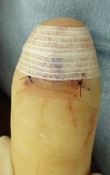手術によるグロームス腫瘍（爪下腫瘍）の治療の流れ7