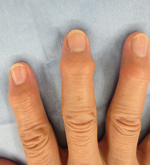 の が 関節 腫れる の 手 指