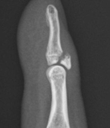 槌指骨折のレントゲン図