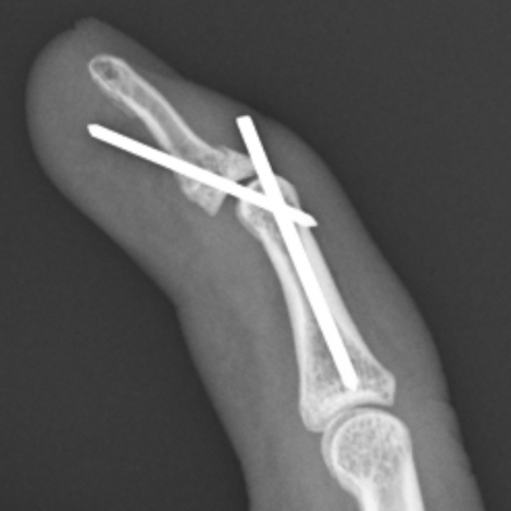 金属（鋼線）固定による槌指骨折の治療レントゲン図1