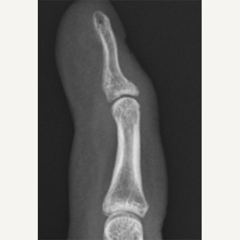 金属（鋼線）固定による槌指骨折の治療レントゲン図2