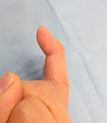 腱性槌指の症状のイメージ