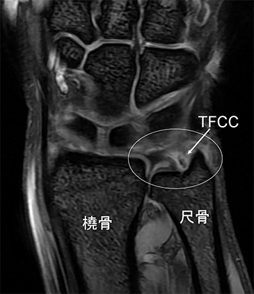TFCC（三角線維軟骨複合体）損傷のレントゲン図