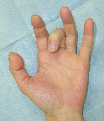 ばね指（腱鞘炎）の症状