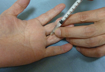 ばね指（腱鞘炎）の注射による治療